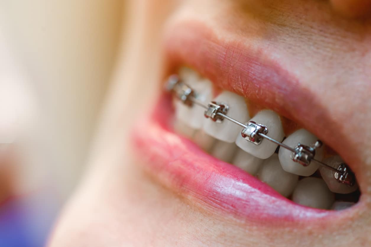 Self-Ligating Braces in Kent, WA